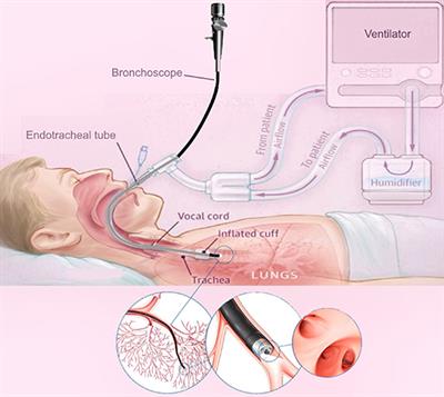 Design and Modelling of a Continuum Robot for Distal Lung Sampling in Mechanically Ventilated Patients in Critical Care